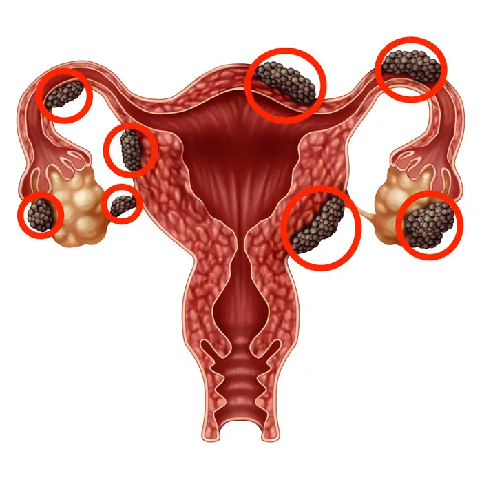 Endometriozis Nedir